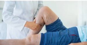 safe varicose vein treatment